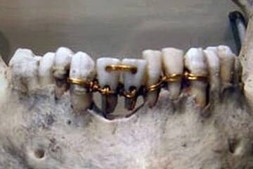 고대 이집트에서 발견된 치아를 금실로 엮어서 고정시켜둔 사진