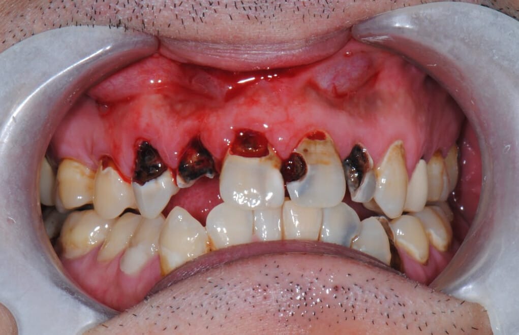 Premium insurance-covered dental filling at Dolgogae Sarang Dental Clinic (GI 보험 치료전)